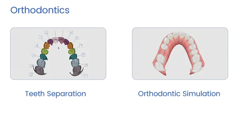 Módulo de ortodoncia del escáner Aidite: separación de dientes y simulación